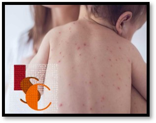 En Campeche, aumentan contagios de varicela en menores.